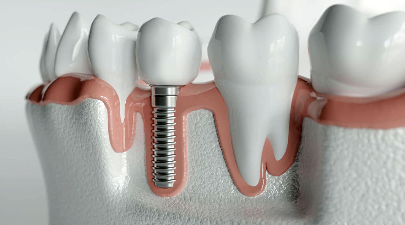 Implant Dis Tedavisi