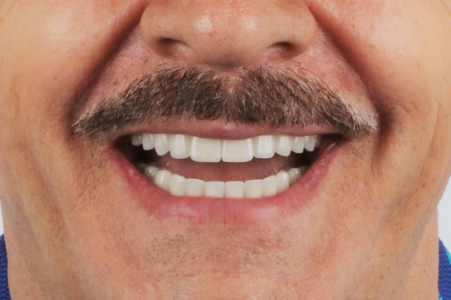 dental clinic veneers after