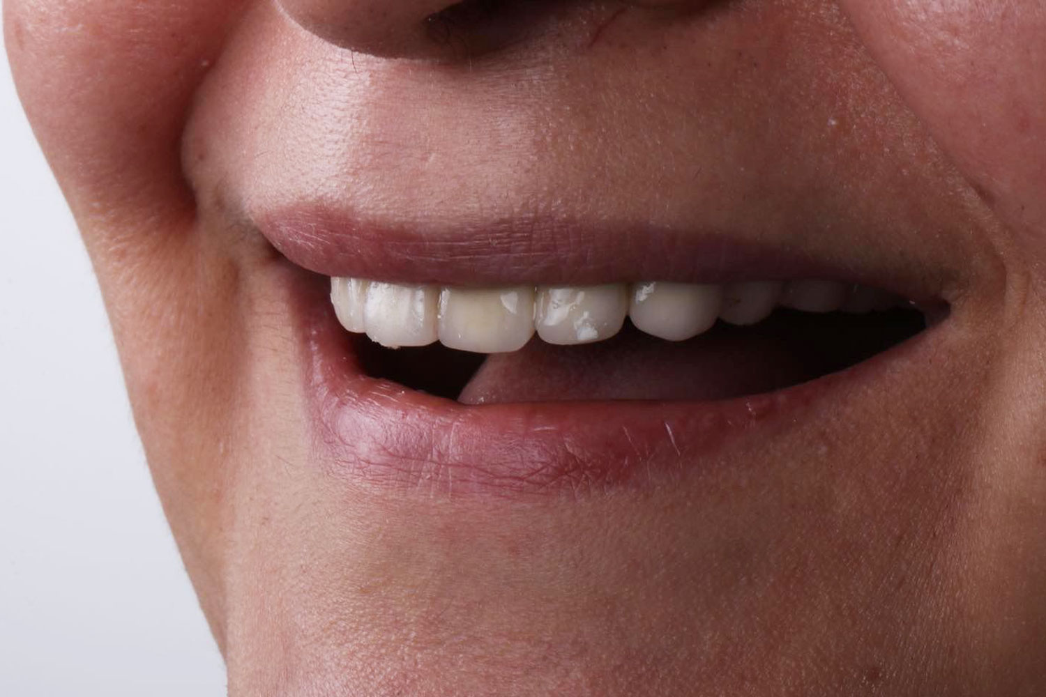 dental veneer before turkey