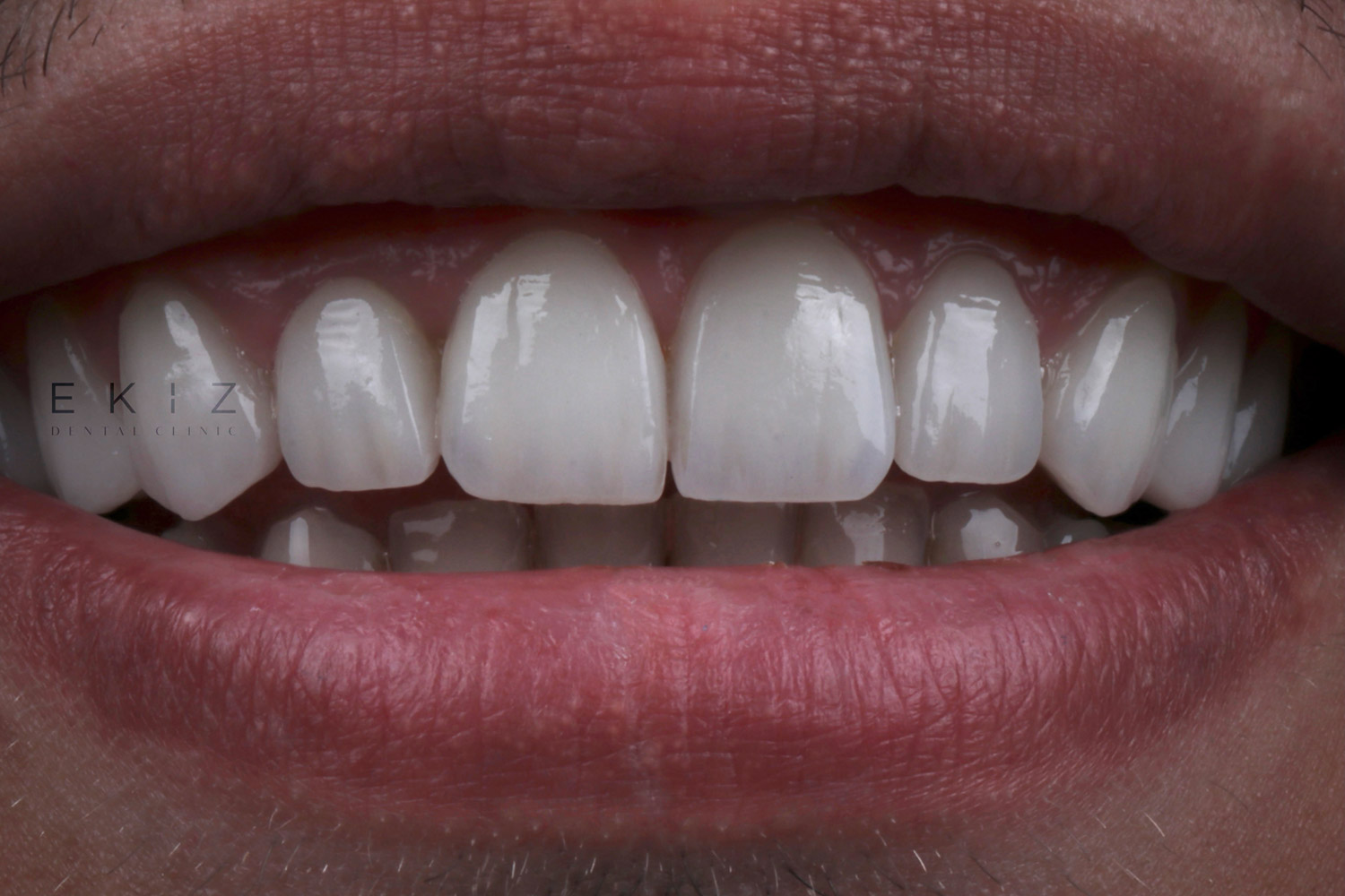 veneer after