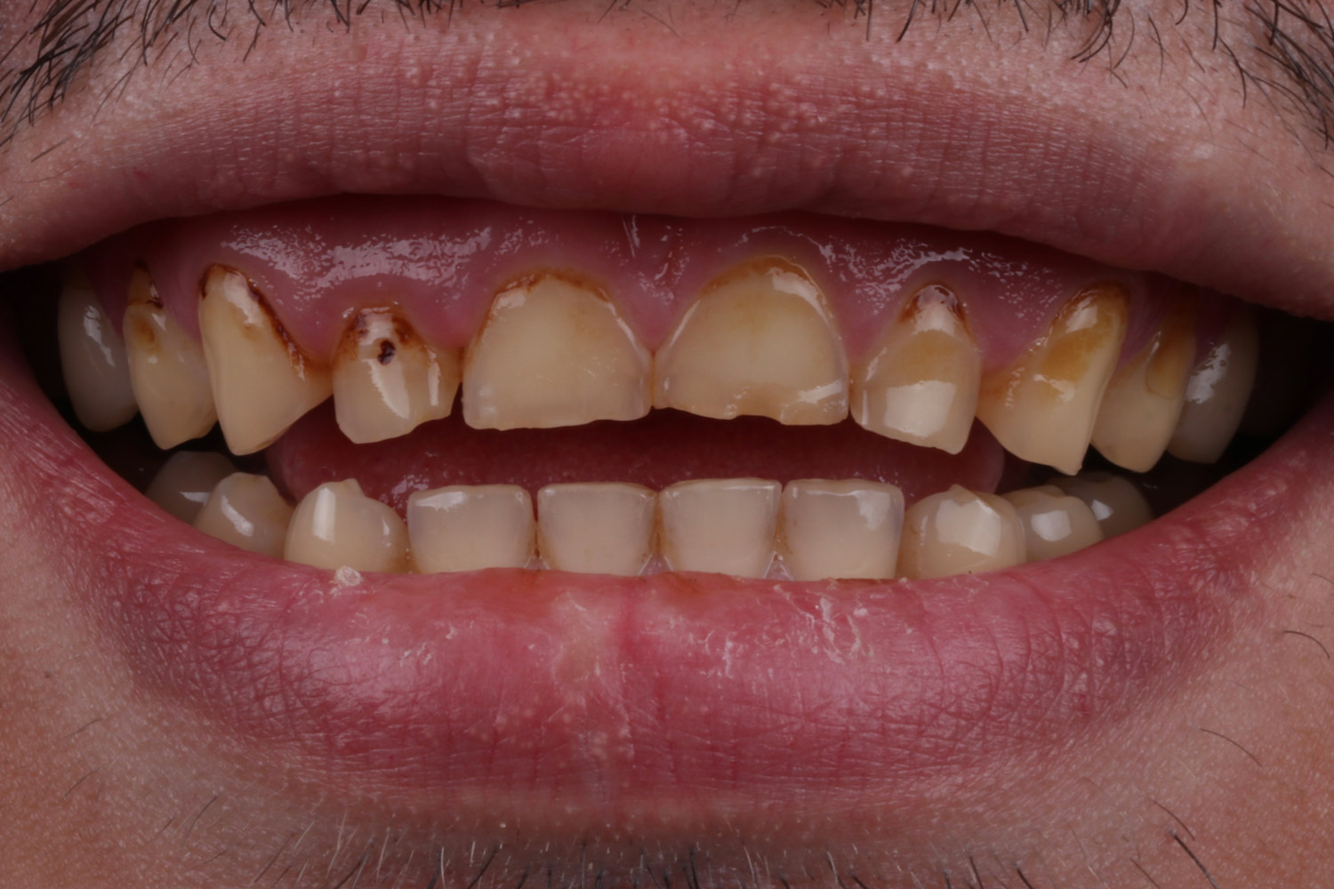 veneer before