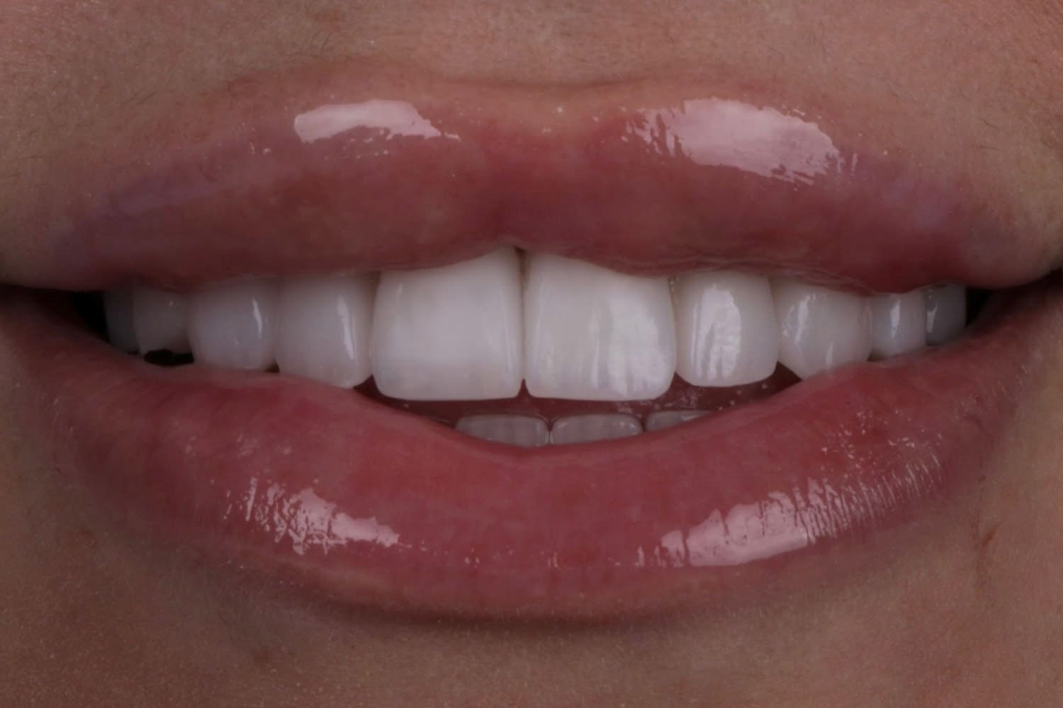 emax veneer turkey after treatment