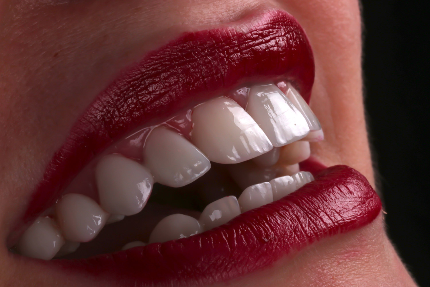 smile makeover emax veneer after