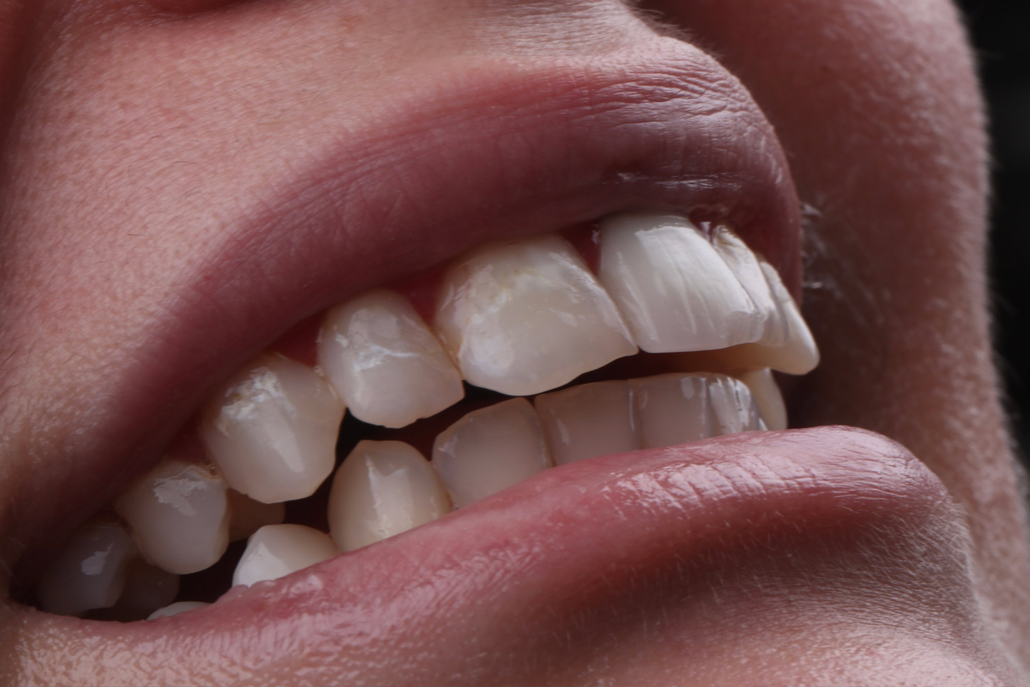 smile makeover emax veneer before