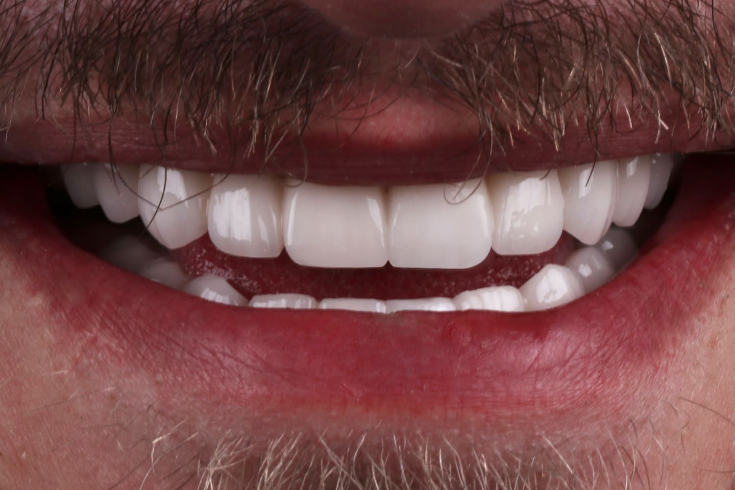 emax veneer after patient1