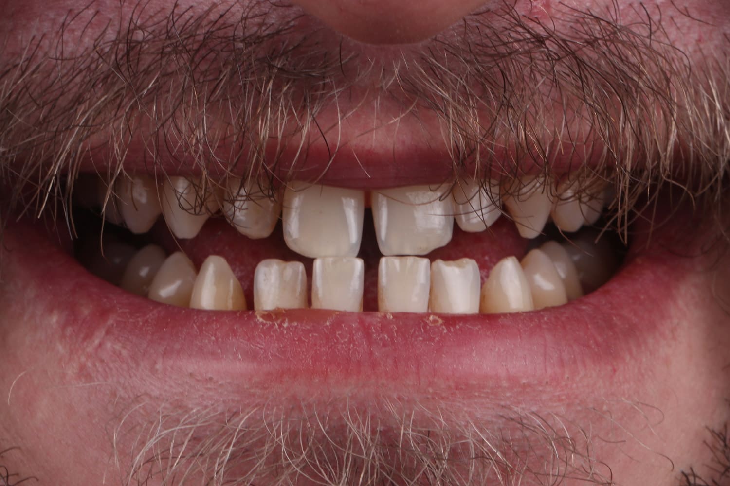 Patient 3 9 emax veneer before patient1