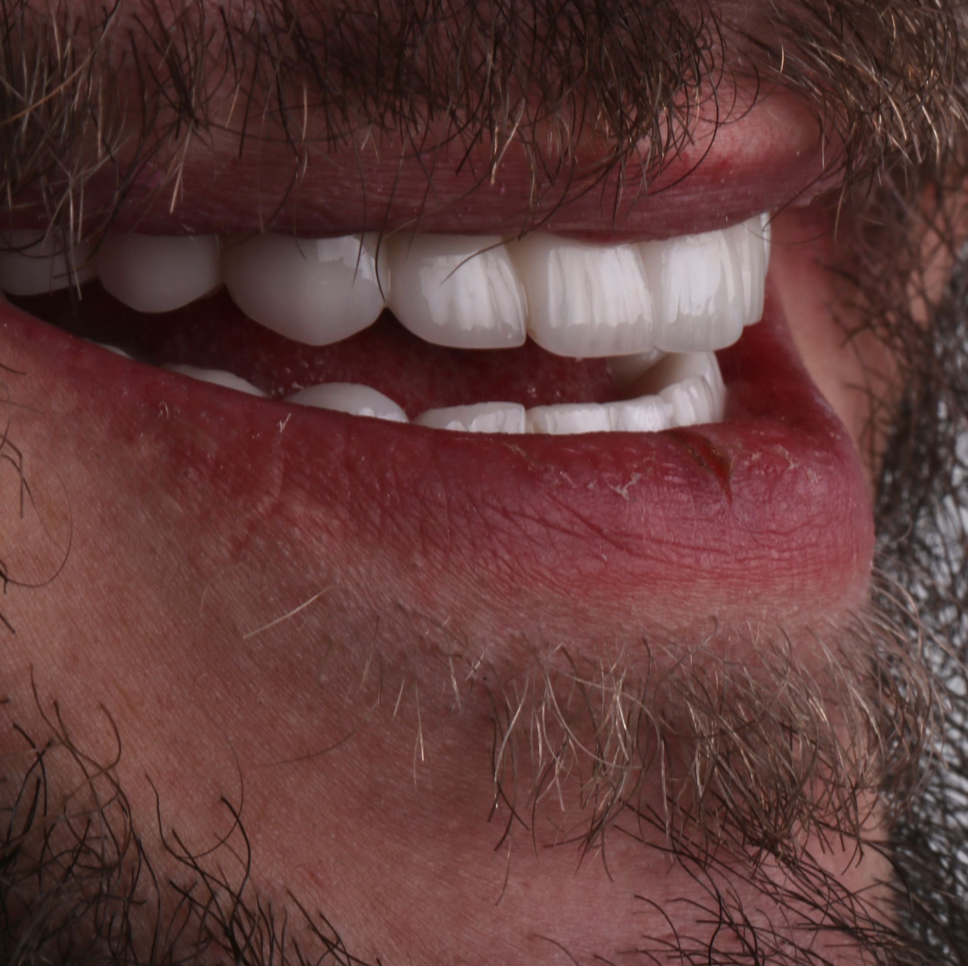 veneer treatment turkey after