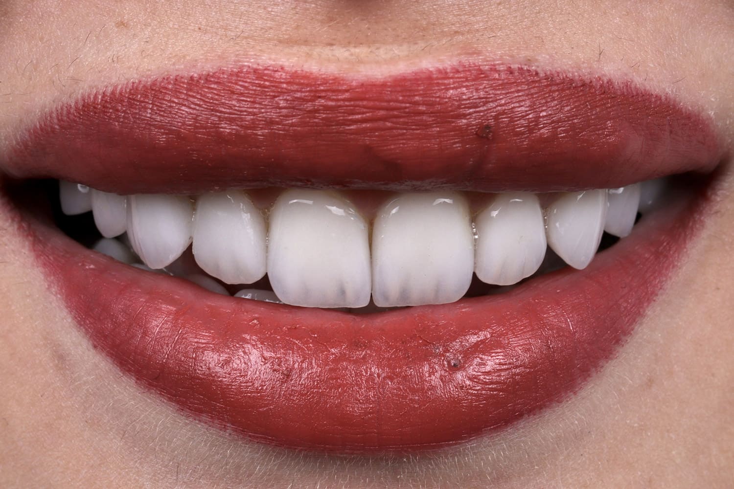 emax dental after