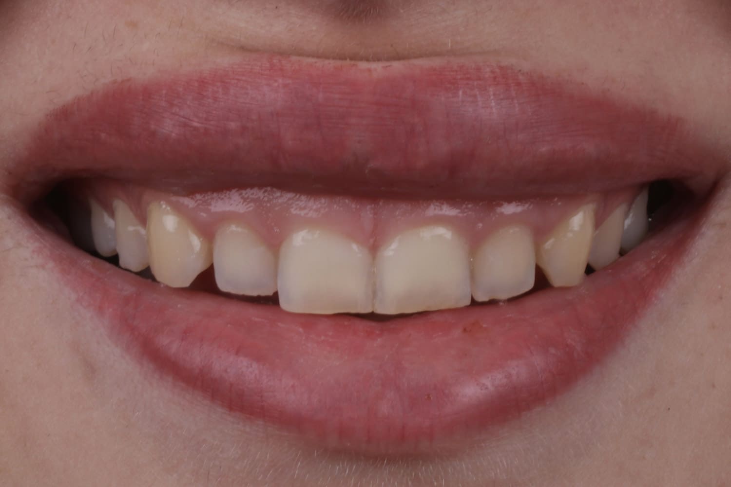 emax dental before