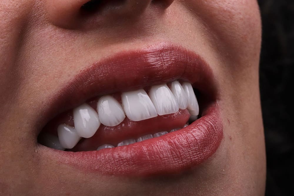 emax veneers