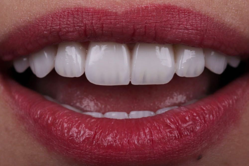 nonprep veneers in turkey
