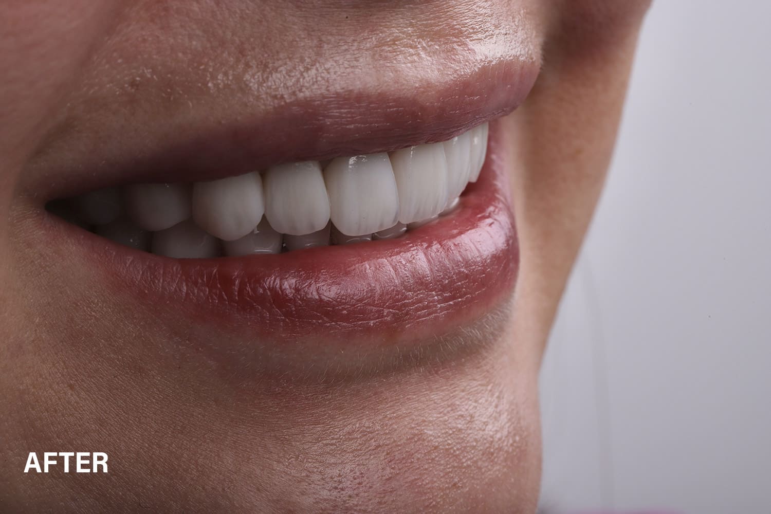 After smile club treatments