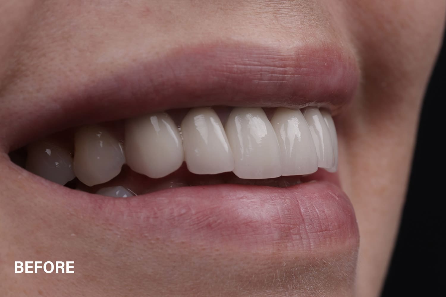Before smile club treatments