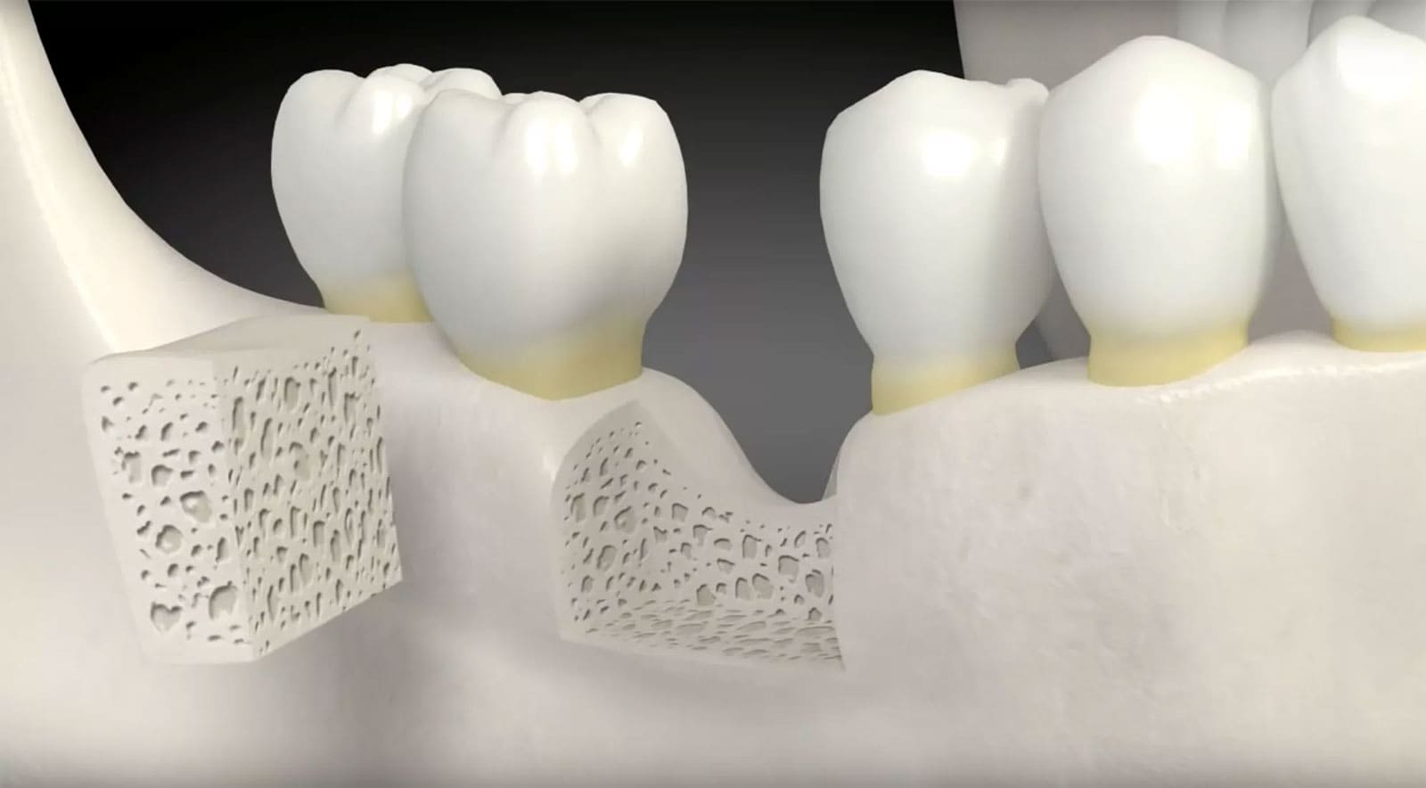 Bone Dust Graft Bone Replication in Turkey