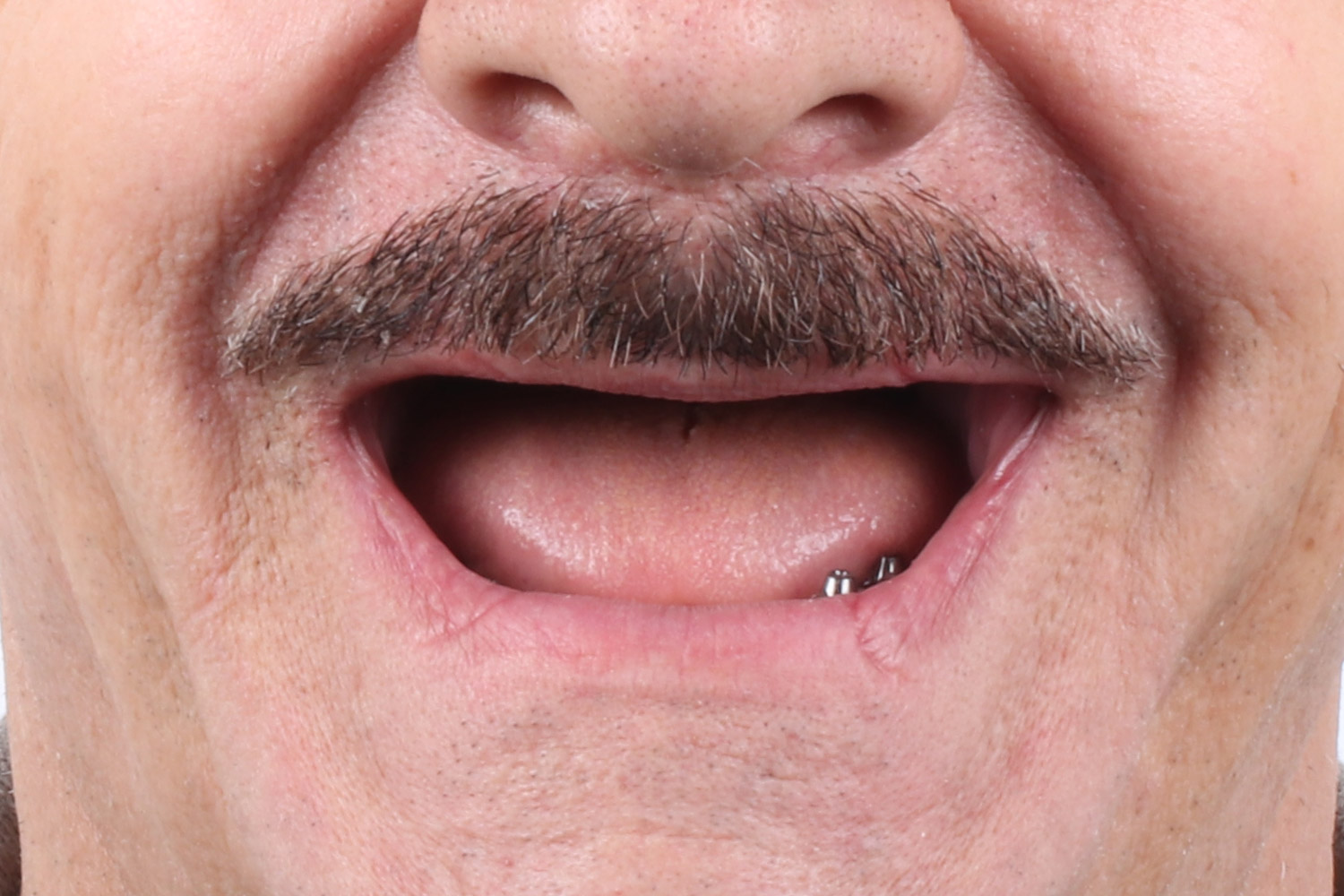 Dental Implant Treatment in Turkey 13 Dental Implant Treatment in Turkey