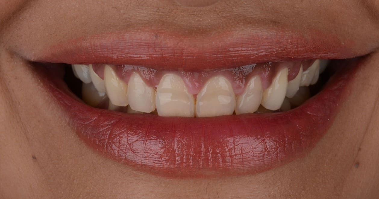Gum Aesthetics Turkey After