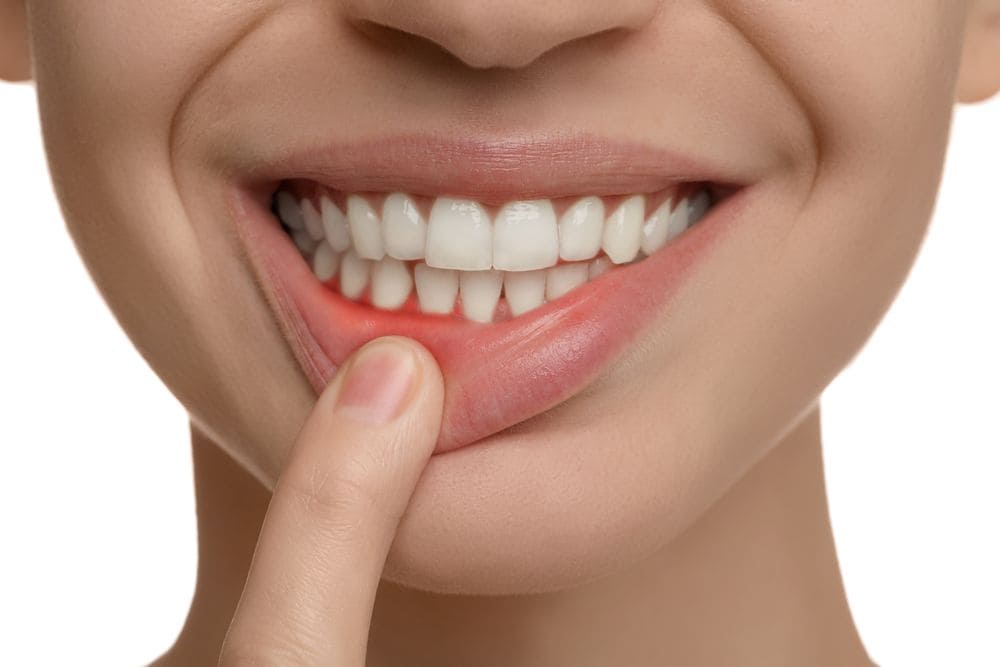 Gum Diseases And Treatment in Turkey