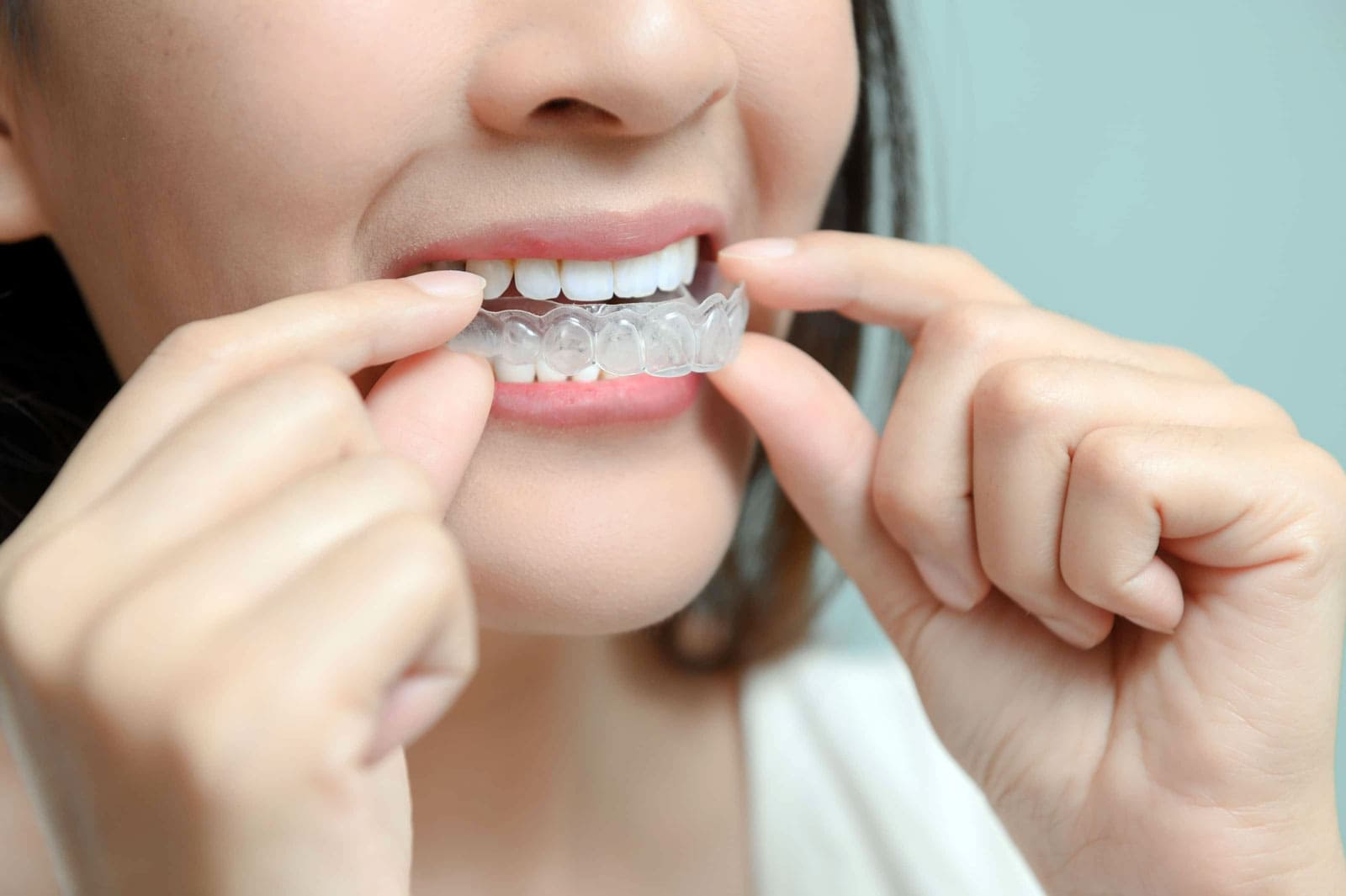 Invisalign Orthodontic Treatment Braces Options in Turkey1