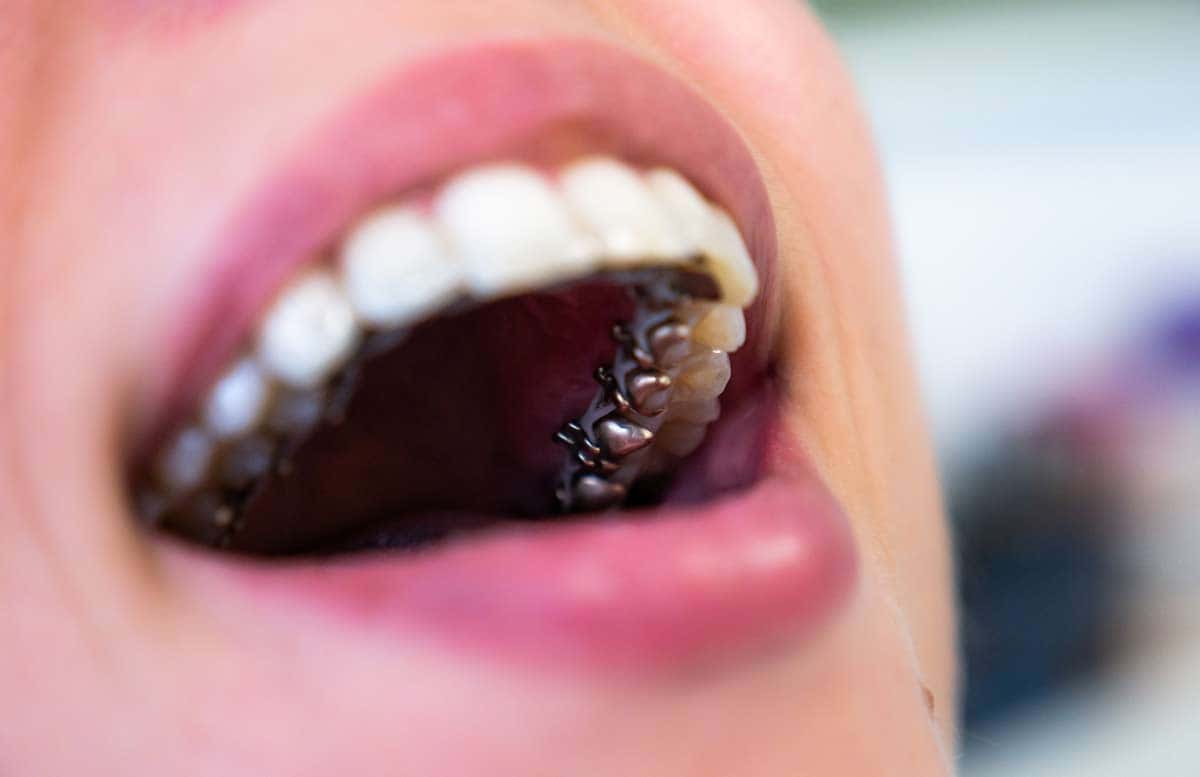 Lingual Braces in Turkey