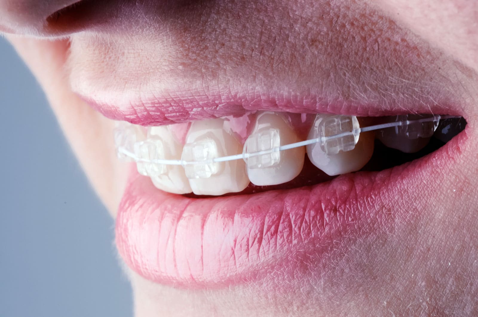 Porcelain Transparent Braces in Turkey