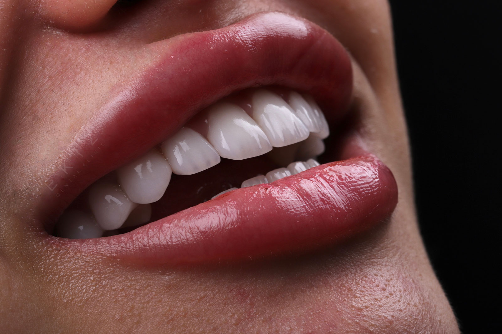 Emax Veneers in Turkey