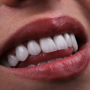 Porcelain Laminate Tooth in Turkey - Leaf Porcelain Teeth in Turkey