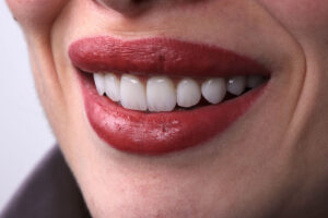 Zirconium Veneers in Turkey