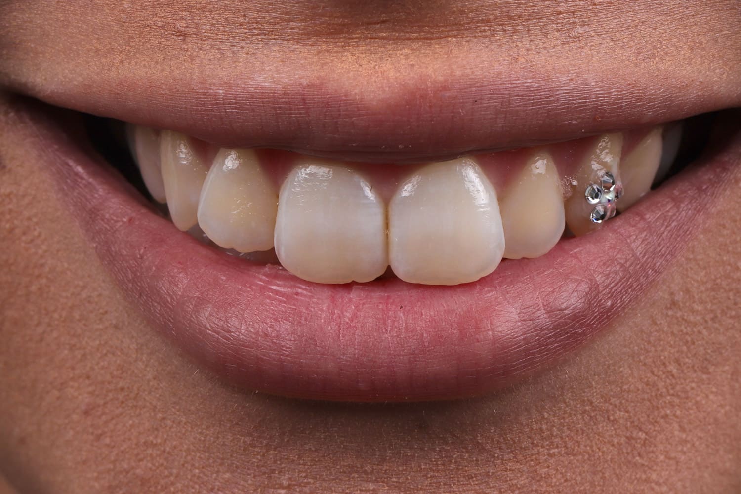 emax veneer ekiz clinic istanbul before