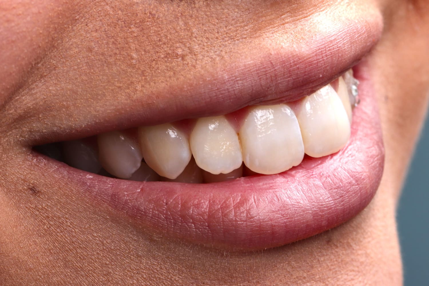 emax veneer treatment before