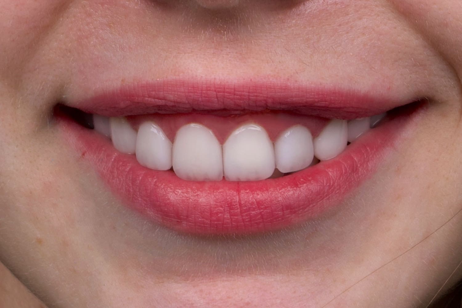 emax veneer treatment istanbul ekiz clinic after