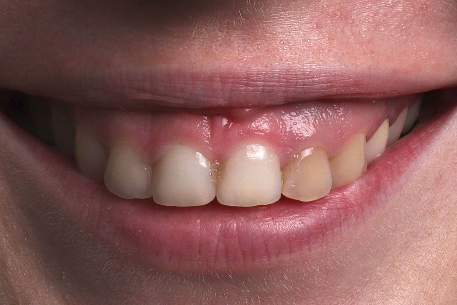 emax veneer treatment istanbul ekiz clinic before