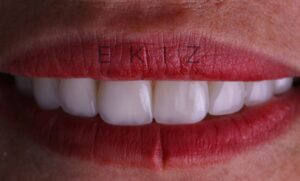 Zirconia Crown | Zirconium Veneers Cost Turkey