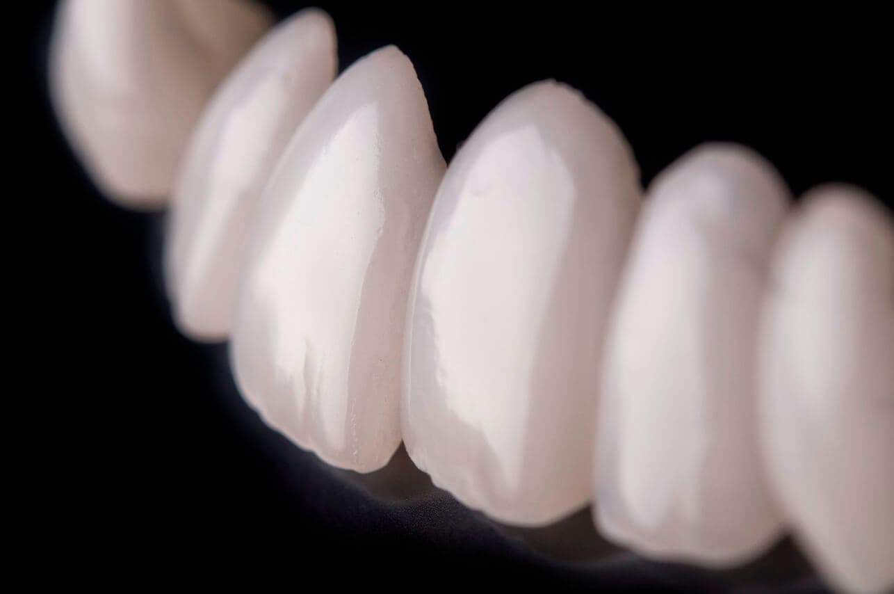 E-max-Zirconia Crowns-Turkey