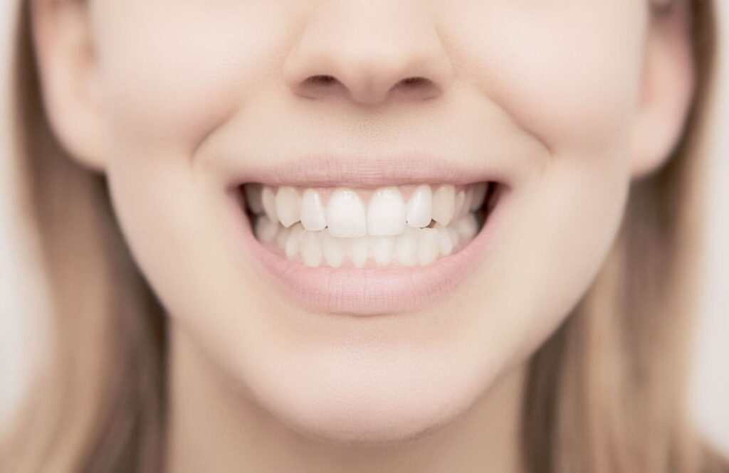Veneers and Bonding for Gummy Smiles