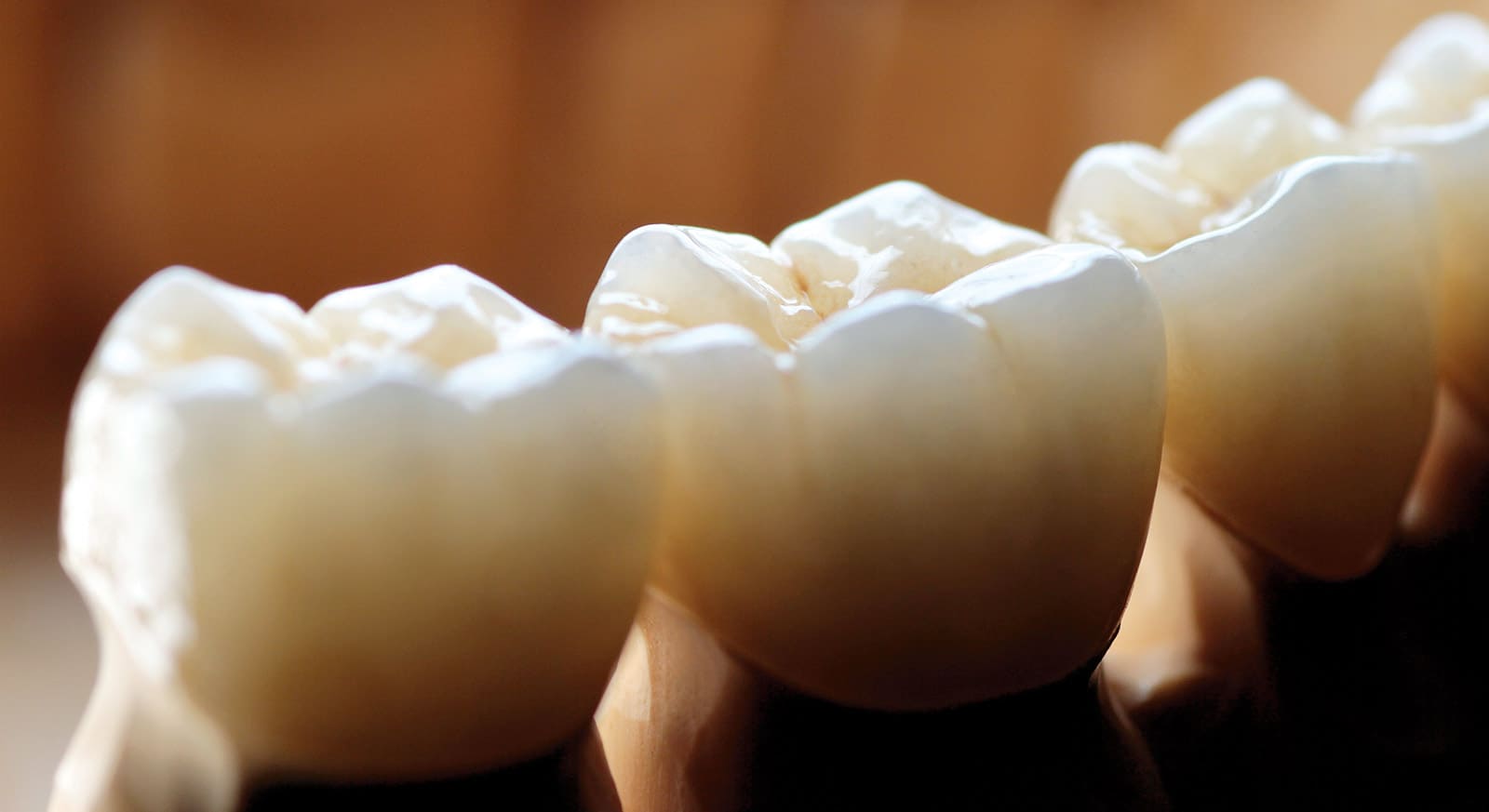 What is the difference between E.MAX and Zirconia Crowns?