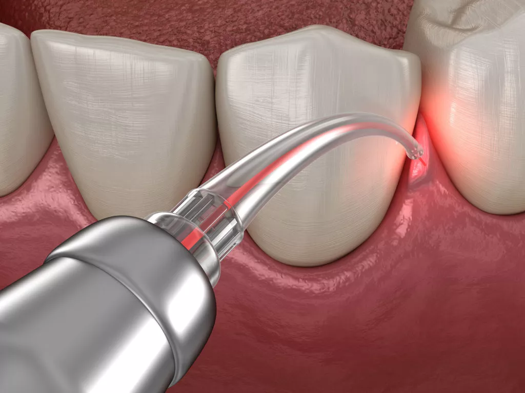 laser dentistry turkey