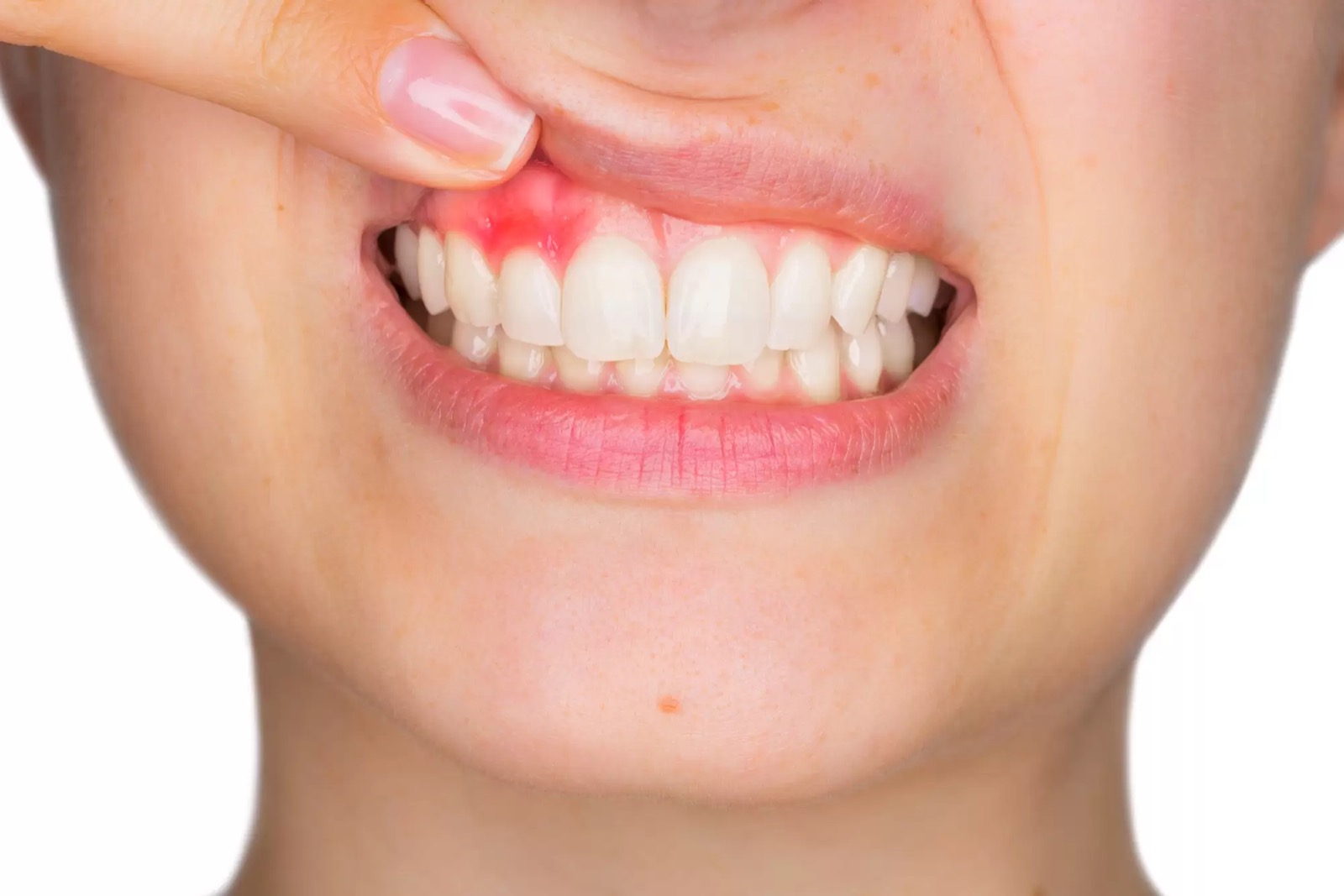 Bleedings Gums