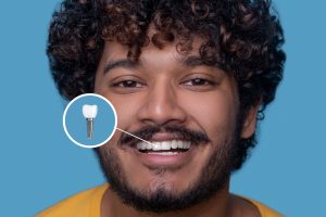 dental implant