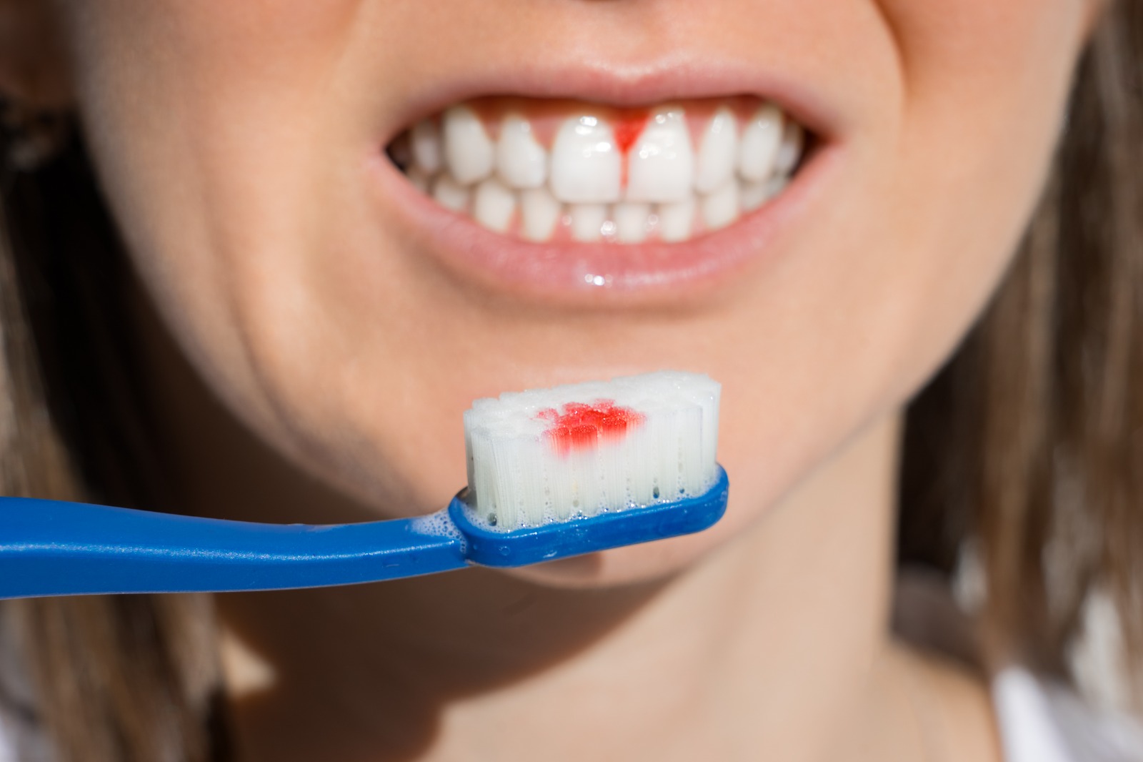 Bleedings Gums