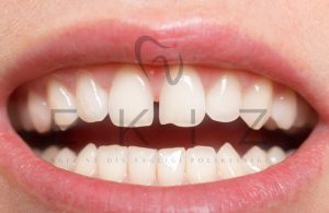 Gap Tooth treatment