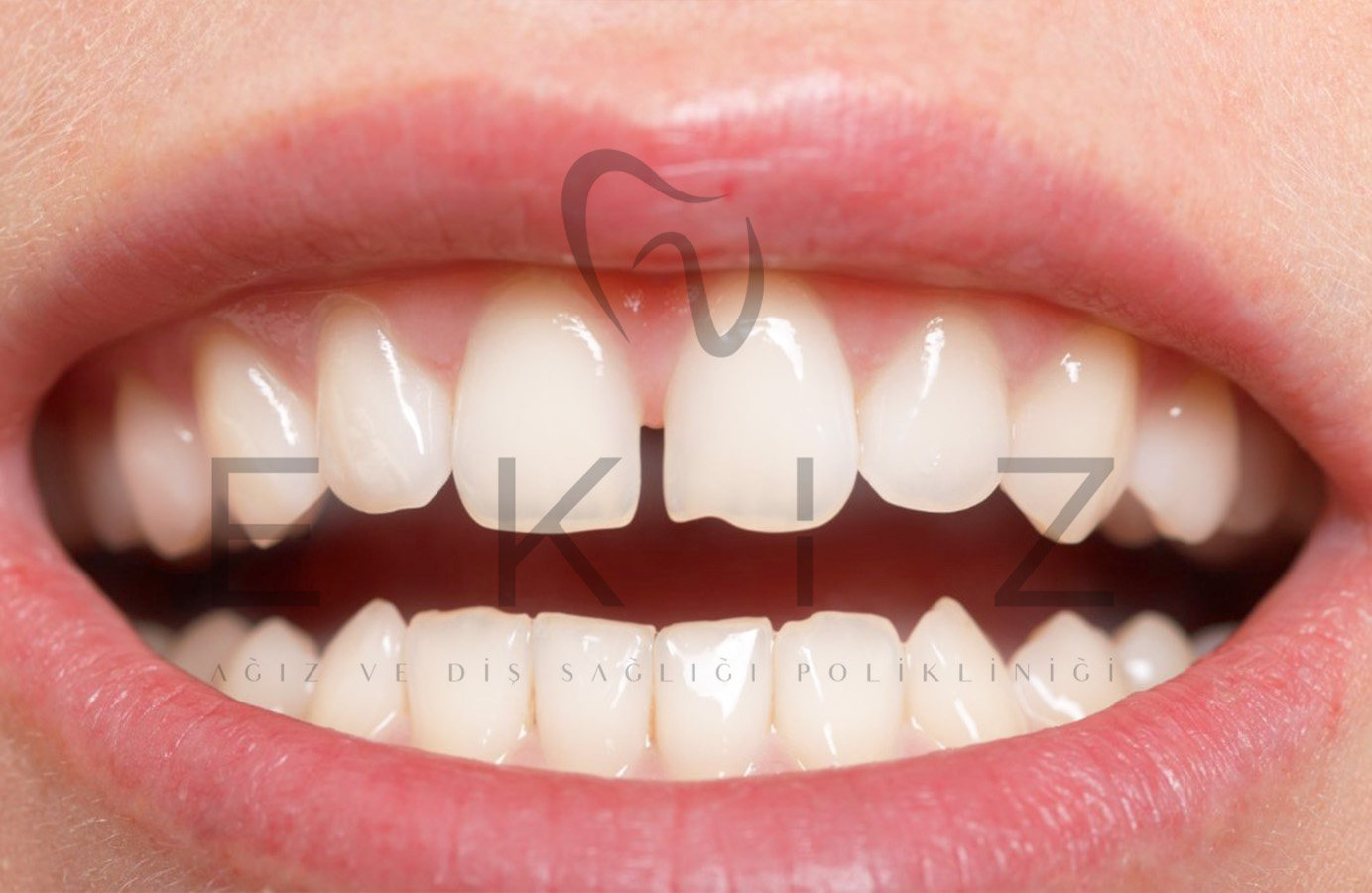 Gap Tooth treatment