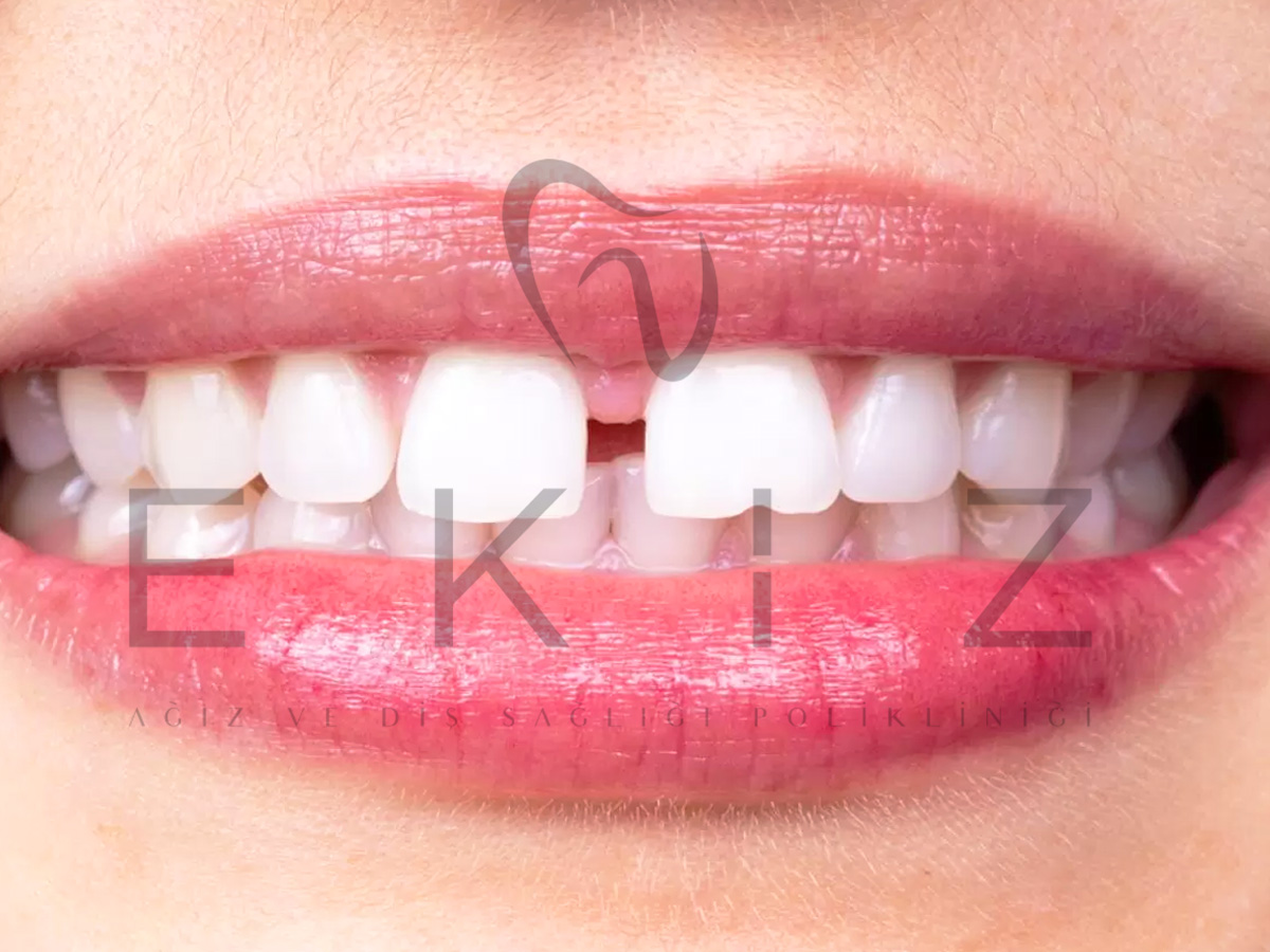 Diastema treatment
